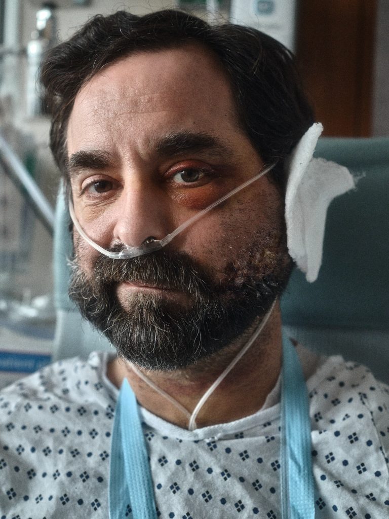 A man with dark hair and a beard in a hospital gown with gauze on his ear and a swolen eye. 